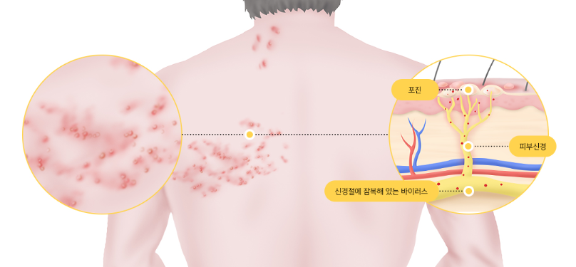 대상포진 증상 전염성 예방접종 초기증상 수포 병원 바로가기